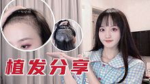 秃子的植发分享！告别大脑门儿的第一个月！