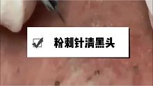 #强迫症 #挤痘痘 #闭口 这款除螨皂用一次你就会爱上 真的好用