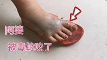 阿婆今早被毒蛇咬到脚大拇指、整只脚都发青了全是毒液
