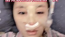 接下来几天我会跟大家分享一下肋骨鼻恢复全过程、不喜欢看轻喷 #肋骨鼻 #记录我的肋骨鼻