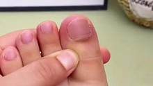 甲沟炎不再是绝症了，有了这个就可以痊愈#指甲矫正神器 #甲沟炎克星