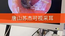 #可视采耳 #强迫症必看 外耳道湿真诱发的中耳盐，真的不要忽视