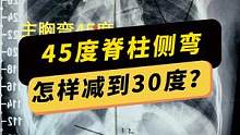超过40度的#脊柱侧弯 怎么办？还可以保守吗？#施罗斯矫形体操#医学科普 