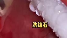 洗牙结石，观看此视频请屏住呼吸，捂住鼻子，#洗牙 #牙齿 #解压
#解压 