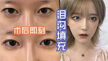 【干货】泪沟黑眼圈救星|医美分享嗨体填泪沟