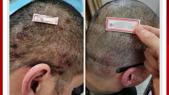 头癣案例—东莞肤康