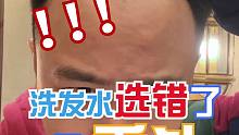 洗发水选错了真的会秃头！掉发早发现早处理还有救！