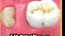 这颗牙齿生锈了！小哥深入研究，发现了极度舒适的东西！#解压 #极度舒适 #拔智齿 #肉松 