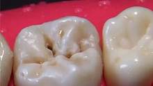 模型演示龋齿修复全过程，牙齿被掏空，牙医可以完美修复 #口腔健康 #蛀牙 #牙齿 #口腔科普 #补牙
