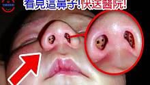 [TOP4]数个鼻子裡取出的怪物与诡异现象 | 鼻子裡的牙齿 | 藏于鼻子18年的违禁品|搬运