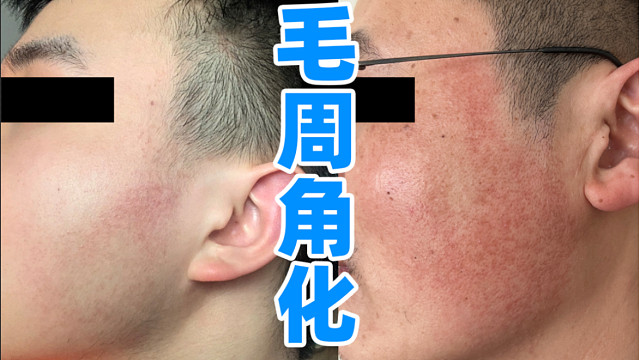 低成本改善面部"鸡皮肤",脸上的毛周角化怎么治?