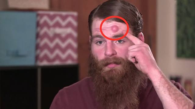 小伙头上长了个犄角,医生开刀一看,竟是一滩"土豆泥"!