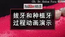 如今种植牙是大部分缺牙患者的首选修复方式，而医生是如何从拔牙到种下一颗逼真的假牙的呢？让我们一起跟随
