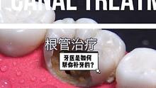 躺着听牙医操作各种器械的声音时，都十分好奇医生是如何”折磨“我们牙齿的，下面跟随模型演示看看补牙的全