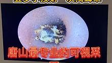 #可视采耳 去过几次一院都没有办法掏出来、到苏杰可视采耳轻松掏出耳结石
