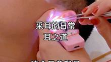 千万不要再用手或者棉签挖耳朵啦，不然就会跟这个兄弟一样#采耳养生 #按摩放松 #专业采耳 #躺下来就