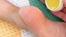 夏天穿凉鞋脚后跟要嫩嫩的才好看，润本皲裂膏要坚持涂，现在涂还来得及#润本皴裂膏 #皴裂膏 