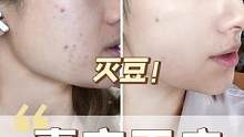 怎么样才可以祛豆=你看完我这期视频+你照着我说的这么做~#淡化痘印 #一起变美 
