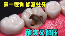 蛀牙修复全过程，看到最后整个人都舒坦了