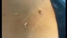 #小肉粒 #去除小肉粒#去除疣体#皮肤健康 #希望能帮到你 