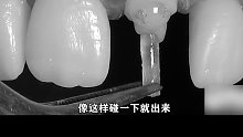 -补牙全过程，解压下饭 舌尖上的牙齿