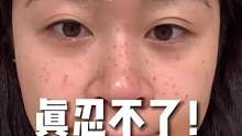 不想被骗就别去做皮M！我这就是活生生的例子，花了米还白受罪！#亲测分享 #变美那些事 #皮肤管理 #