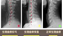 不同形态下的颈椎，快看看您是哪种#体态纠正 #颈椎 #肩颈酸痛 #富贵包 #驼背