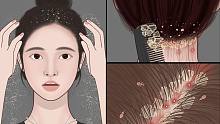 沉浸式头皮清理动画全过程，看完我头皮不痒了|萌大佬动画