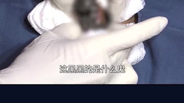 小伙子胸前长了一个大痘痘，医生直接用手挤爆，场面差点失控