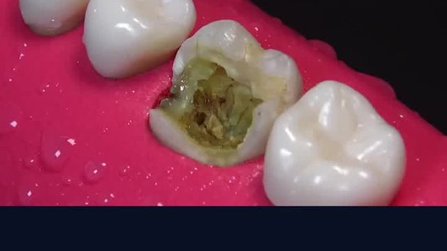 当牙齿被蚜虫吃了以后，该怎么处理牙齿呢？