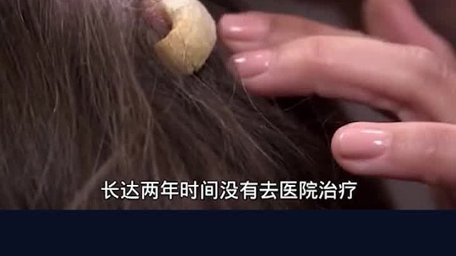 女子头上长了一个类似牛角的东西，而且随着时间增长，也在长大