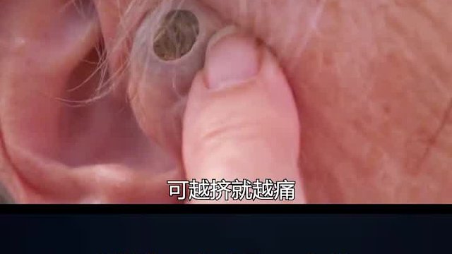 国外老奶奶的耳朵上长了一颗石头，导致耳朵听不见，到底怎么回事