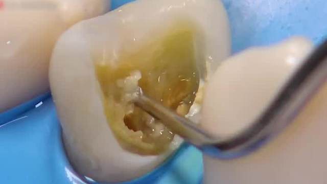 爱护牙齿 看补牙齿