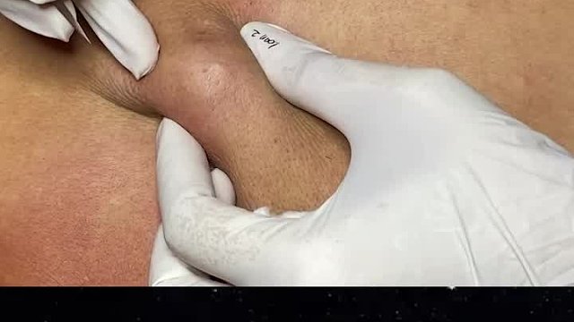 男子背上长了一个大痘痘，医生用刀轻轻一割，瞬间爆浆了