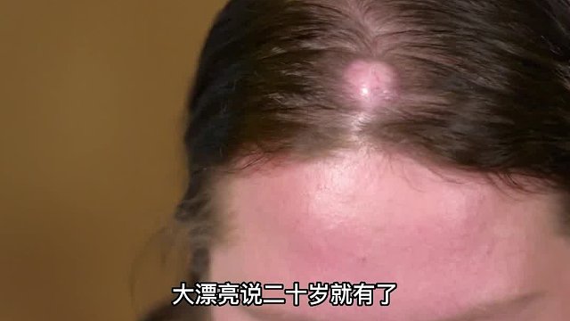 女子额头上长出了鸡蛋大小的痘痘，被人嘲笑怪物，到底怎么回事！