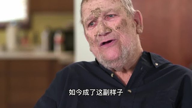 国外男子全身百分八十都是死皮，看起来像怪物，怎么回事！
