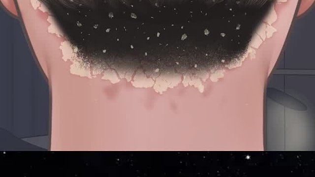 男子几年美洗头，导致头皮上长满了头皮屑，太奇葩了