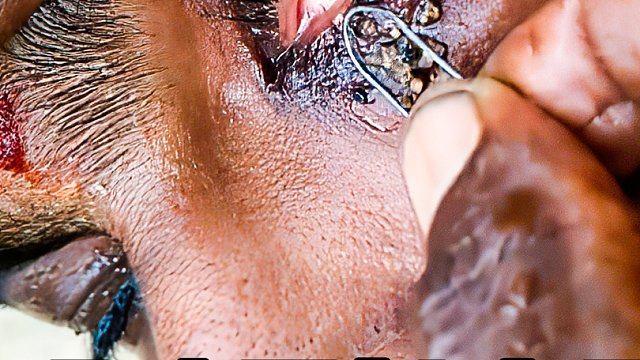 小哥眼里长出虫子，谁知道越清理越多，这波操作太绝了！