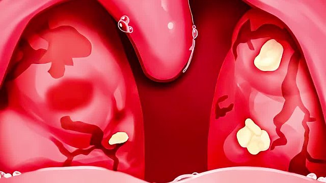 女孩严重口臭失恋了，差点熏晕医生，清理过程十分过瘾