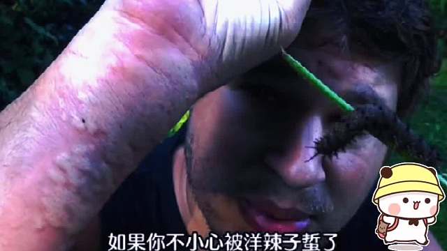 被洋辣子蛰快速解决办法