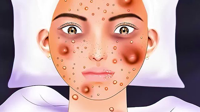 女孩熬夜脸上爬满脓包，看着非常痛苦，清理过程超解压