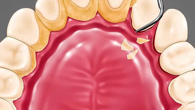 总裁嗜好囤积牙结石，五年没有刷过牙，清理过程超过瘾