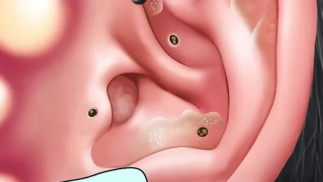 男人只因听了个八卦，耳朵竟然开花了，清理过程超解压