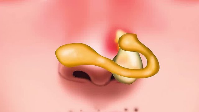 女孩打鼻钉竟变大洞，痛苦的后悔不已，清理过程超解压