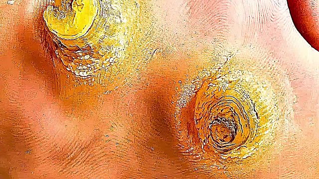 男人有抠脚怪癖，竟然长出超大鸡眼，清理过程超解压