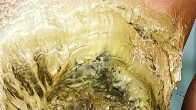 十年没修的大鸡眼，疼的男人龇牙咧嘴，清理过程超解压