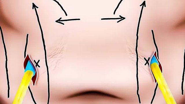 女孩为了做抽脂手术，竟然吃到180斤，减肥过程超解压