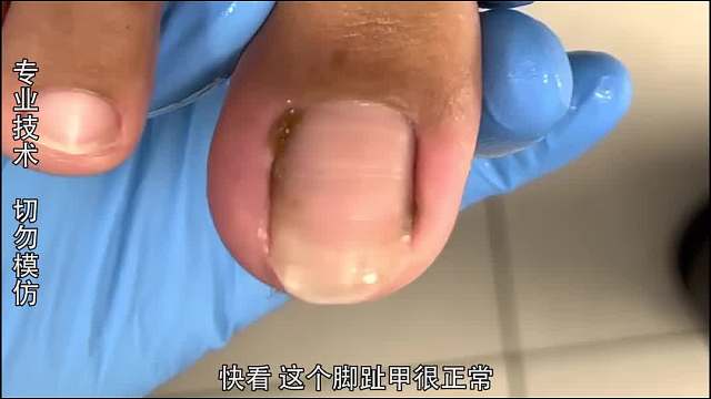 纪录片：看上去十分正常的脚趾甲，竟让修脚师傅也栽跟头！