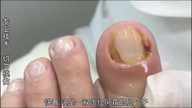 纪录片：爱穿小鞋的小姐姐，甲沟炎资深患者！