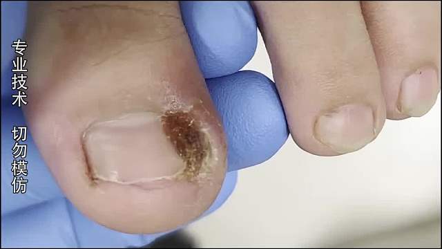 纪录片：小姐姐的脚趾甲内卷严重，与脚趾头的友谊说翻就翻！